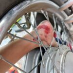 เสียว เตือนภัยผู้ปกครอง เด็ก 5 ขวบ ข้อเท้าติดล้อรถ จยย. กู้ภัยฯเร่งช่วยเหลือ